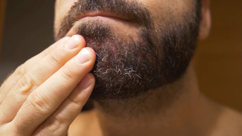 O que fazer para acabar com a coceira na barba