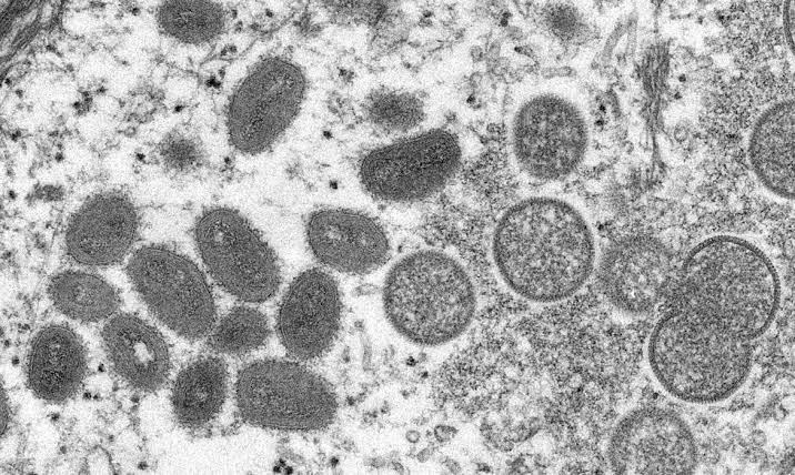 Saúde notifica caso suspeito de monkeypox no Acre