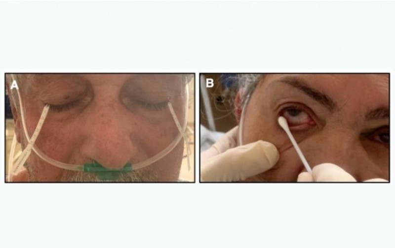 Estudo mostra que COVID-19 pode ser detectado em lágrimas com uso de swab