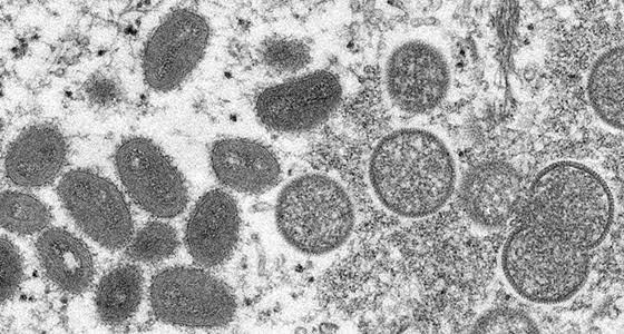 Saúde descarta caso suspeito de monkeypox e notifica mais um em Rio Branco