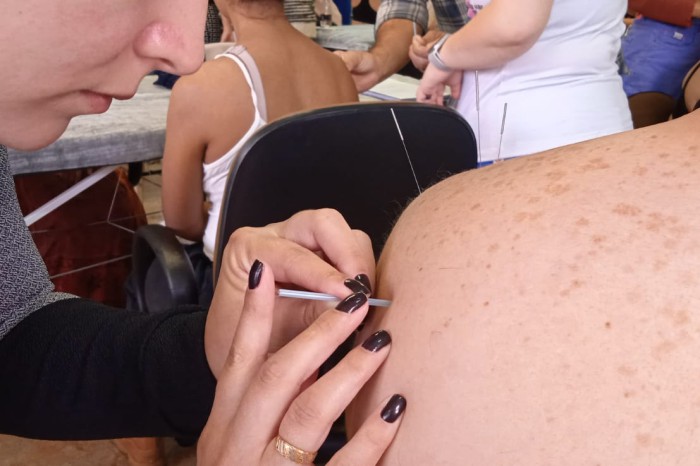 Paraná forma primeira turma de médicos para atuar com acupuntura no SUS